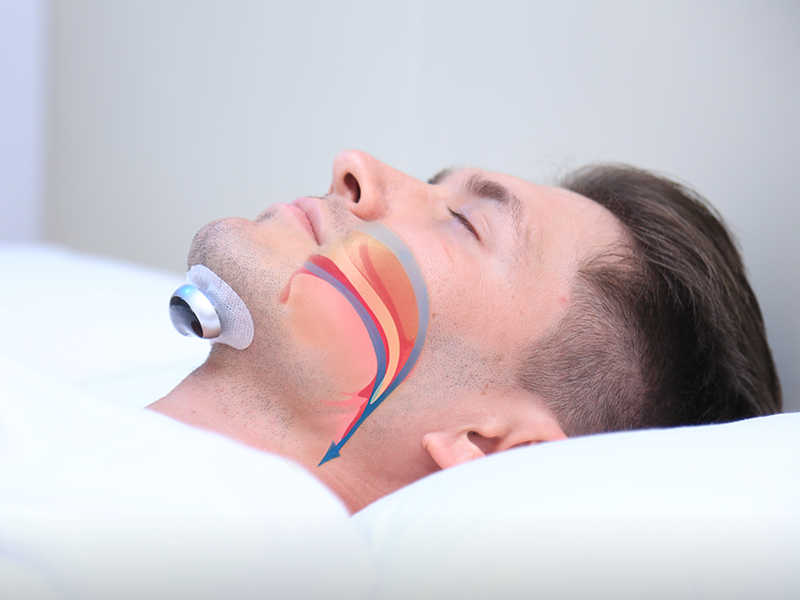 SilentEase – Dispositif Anti-Ronflement pour des Nuits Paisibles